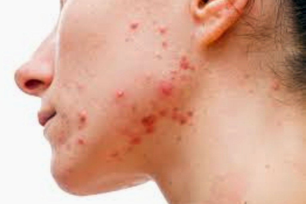 Pimples