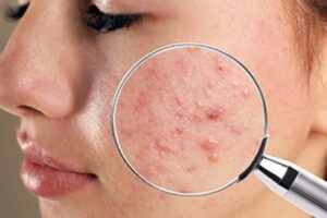 Pimples