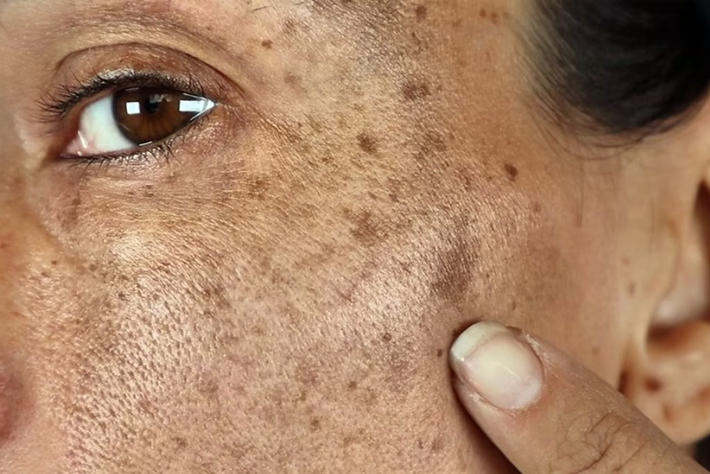 Remove Black Spot on Face