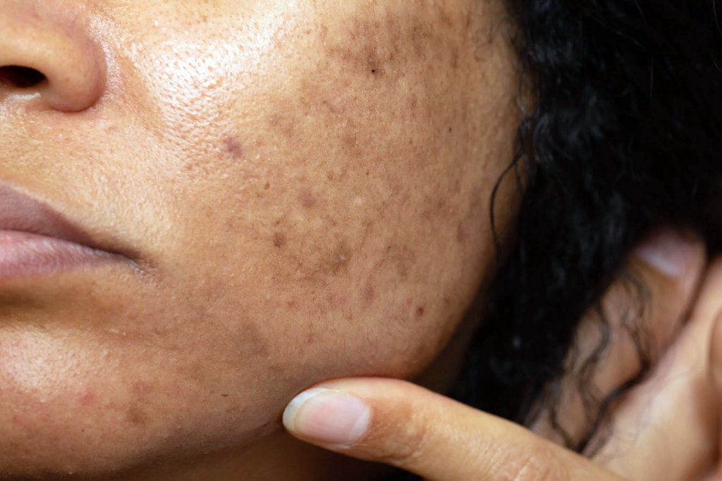 Remove Black Spot on Face