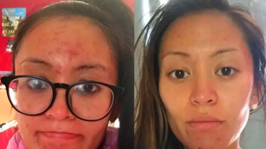 Pimple-Clear Clay Mask