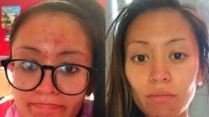 Pimple-Clear Clay Mask