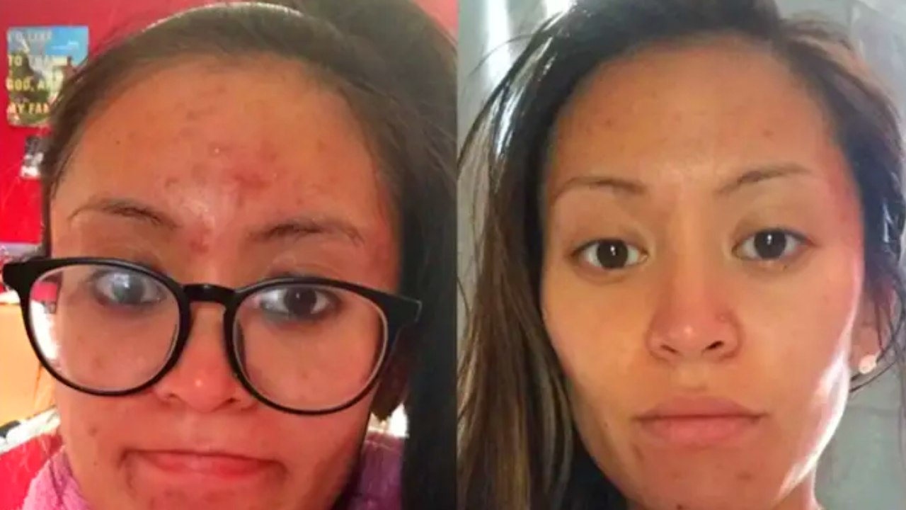 Pimple-Clear Clay Mask